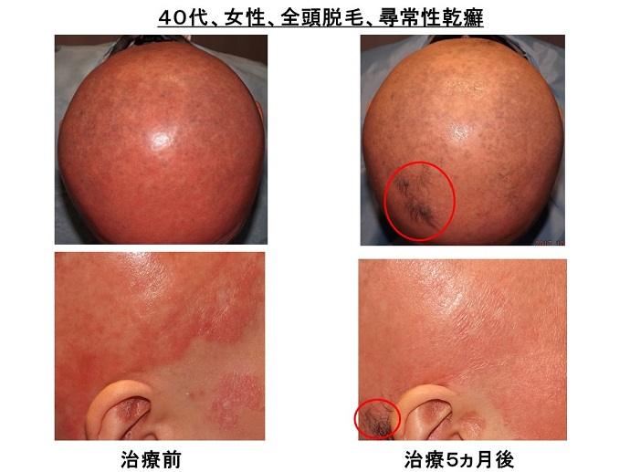 円形脱毛症　病院